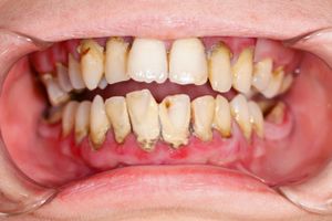 Halvdelen af landets tandlæger svarer i en ny rundspørge, at de har fået flere patienter med syreskader. Pas på med at slukke tørsten i sommervarmen med sodavand og energidrikke, advarer Tandlægeforeningen.